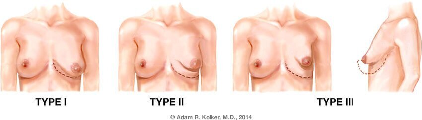 Treatment of Tuberous Breasts