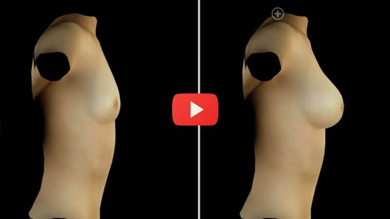 Crisalix 3D Breast Augmentation Simulation