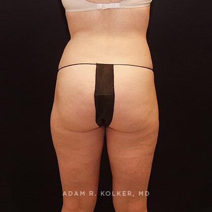 Liposuction After Image Patient 01 Side View