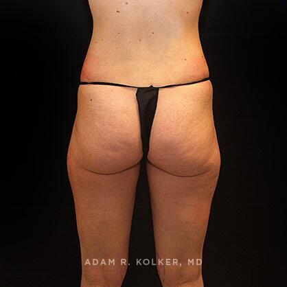 Liposuction Before Image Patient 02 Side View