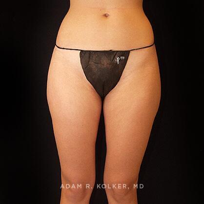 Liposuction Before and After Image