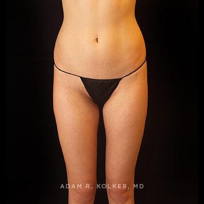 Liposuction After Image Patient 05 Front View