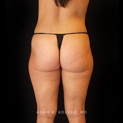 Liposuction Before Image Patient 07 Side View