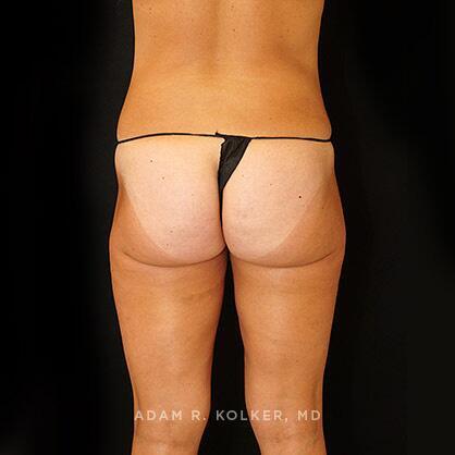 Liposuction After Image Patient 07 Side View