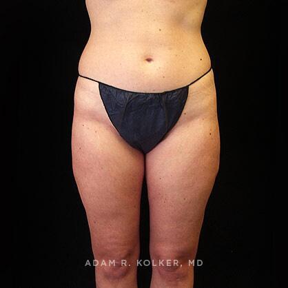 Liposuction After Image Patient 08 Front View