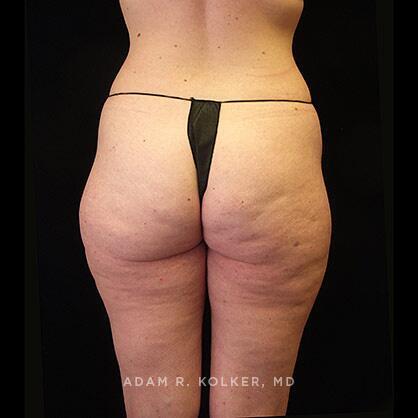 Liposuction Before Image Patient 08 Side View
