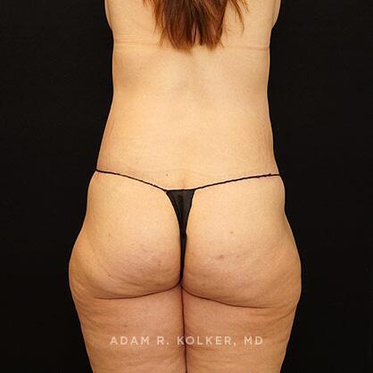 Lower Body Lift Before and After Image