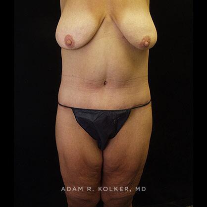 Lower Body Lift After Image Patient 13 Front View
