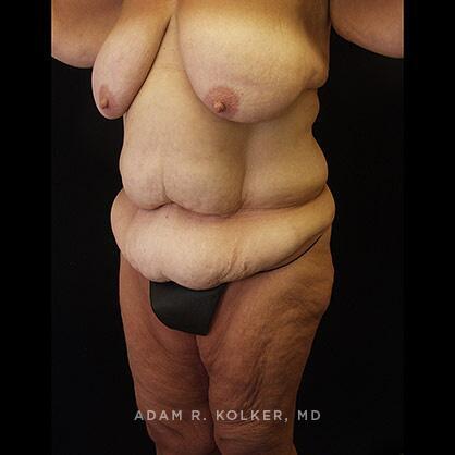 Lower Body Lift Before Image Patient 13 Oblique View