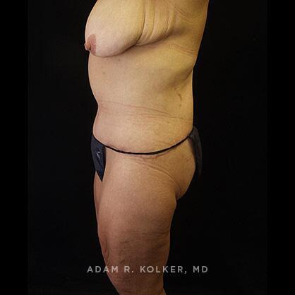 Lower Body Lift After Image Patient 13 Side View