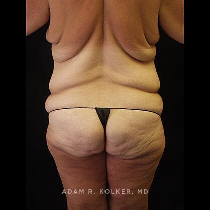 Lower Body Lift Before Image Patient 13 Side View