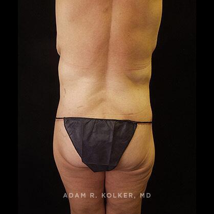 Lower Body Lift After Image Patient 13 Side View