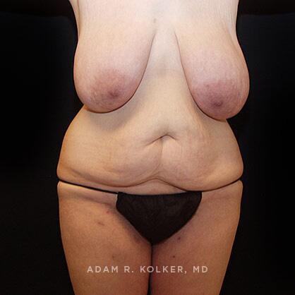 Lower Body Lift Before Image Patient 14 Front View