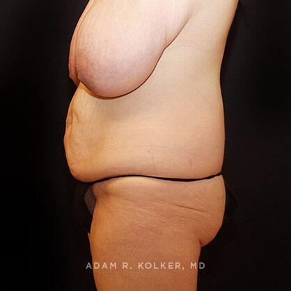 Lower Body Lift Before Image Patient 14 Side View