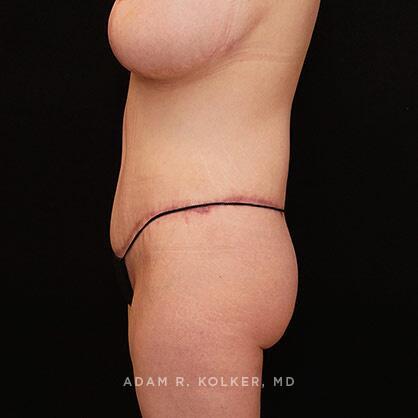 Lower Body Lift After Image Patient 14 Side View