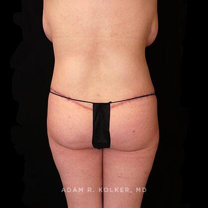 Lower Body Lift After Image Patient 14 Side View
