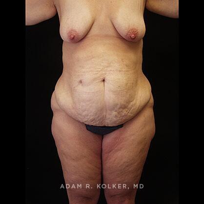 Lower Body Lift Before Image Patient 15 Front View