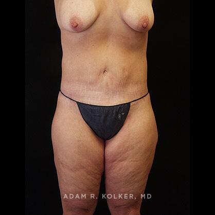 Lower Body Lift After Image Patient 15 Front View