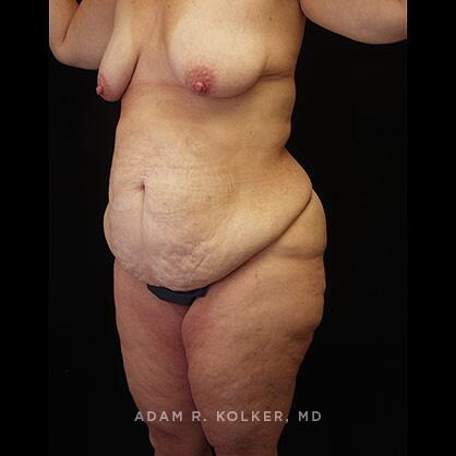 Lower Body Lift Before Image Patient 15 Oblique View