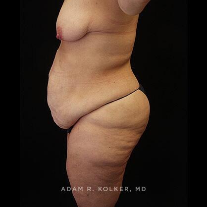 Lower Body Lift Before Image Patient 15 Side View