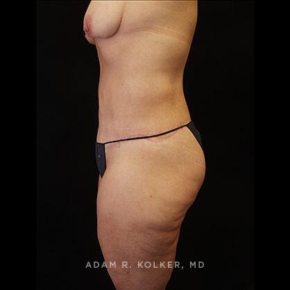 Lower Body Lift After Image Patient 15 Side View
