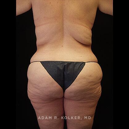 Lower Body Lift Before Image Patient 15 Side View