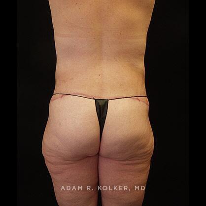 Lower Body Lift After Image Patient 15 Side View
