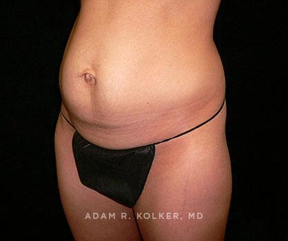 Mommy Makeover After Image Patient 05 Oblique View