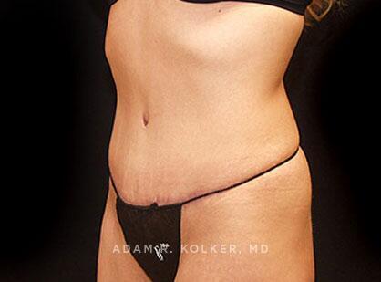 Mommy Makeover After Image Patient 06 Oblique View