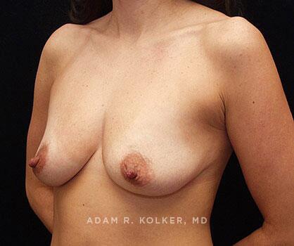 Mommy Makeover Before Image Patient 10 Oblique View
