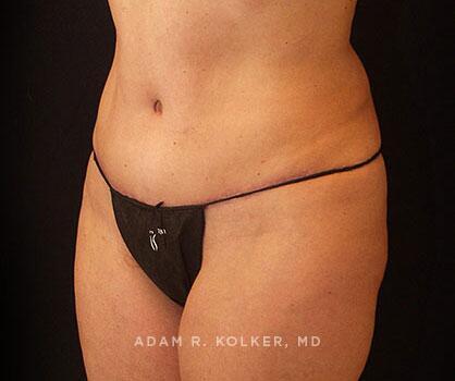 Mommy Makeover After Image Patient 11 Oblique View