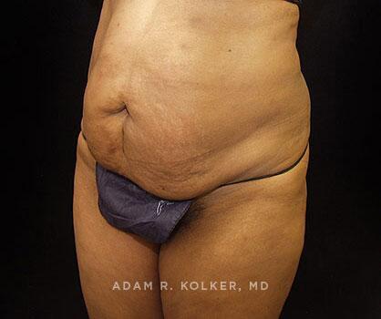 Mommy Makeover Before Image Patient 16 Oblique View