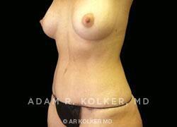 Mommy Makeover After Image Patient 18 Oblique View