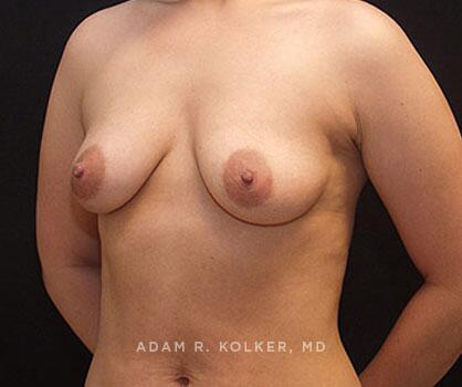 Mommy Makeover After Image Patient 19 Oblique View