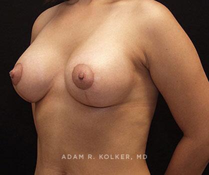 Mommy Makeover After Image Patient 20 Oblique View