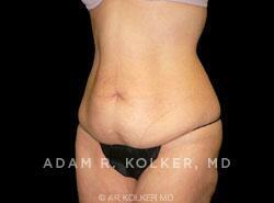 Surgery After Weight Loss / Post Bariatric After Image Patient 05 Oblique View