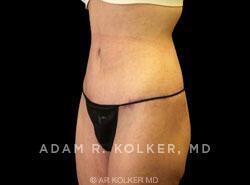 Surgery After Weight Loss / Post Bariatric After Image Patient 05 Oblique View