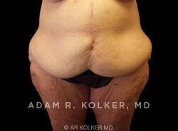 Surgery After Weight Loss / Post Bariatric Before Image Patient 07 Front View