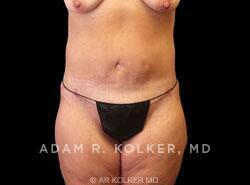 Surgery After Weight Loss / Post Bariatric After Image Patient 08 Front View