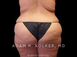 Surgery After Weight Loss / Post Bariatric After Image Patient 08 Side View