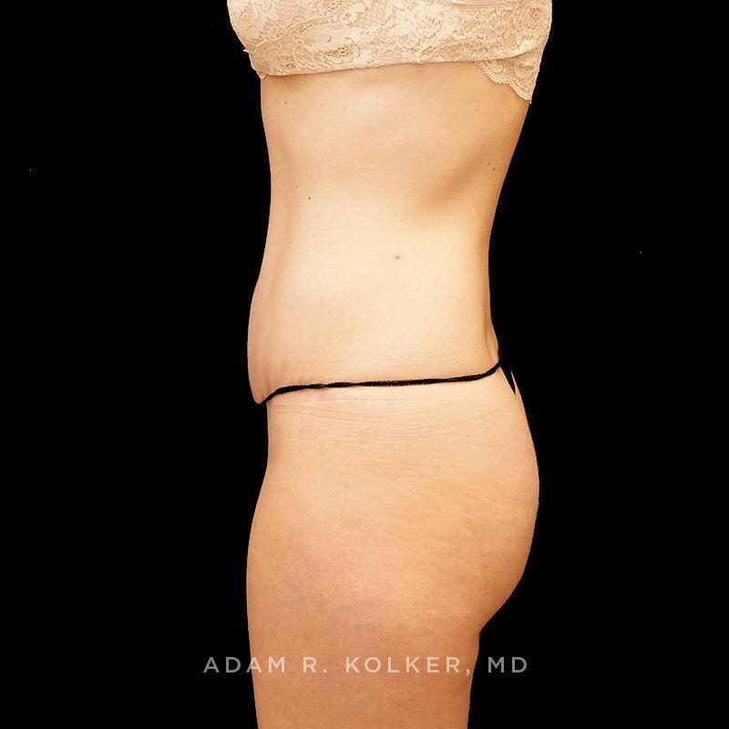 Tummy Tuck After Image Patient 04 Side View