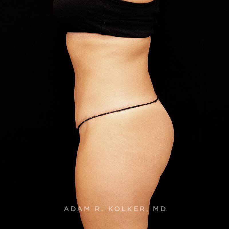 Tummy Tuck After Image Patient 05 Side View