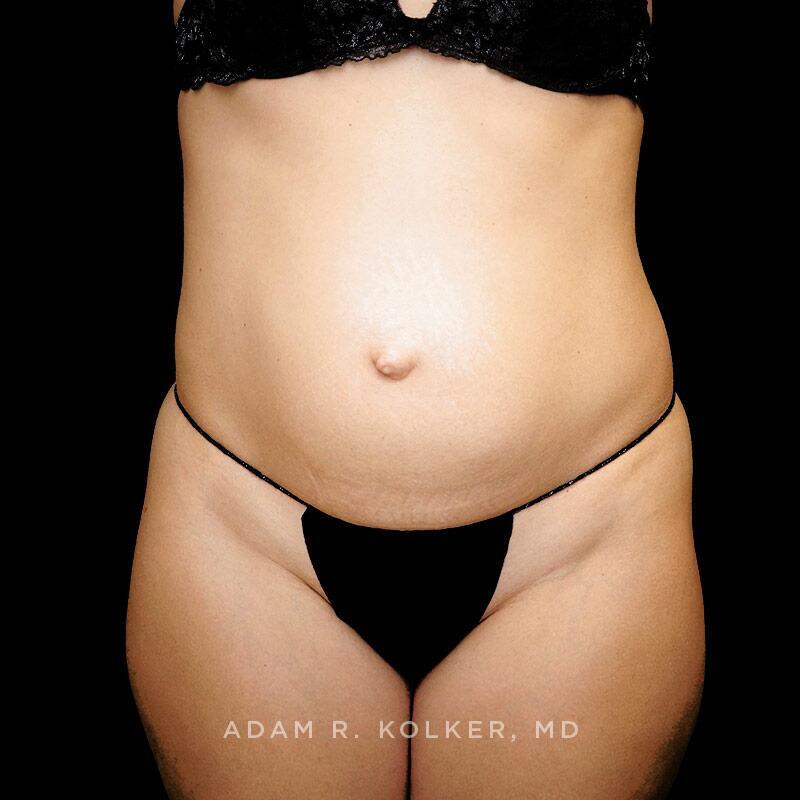 Tummy Tuck Before Image Patient 08 Front View