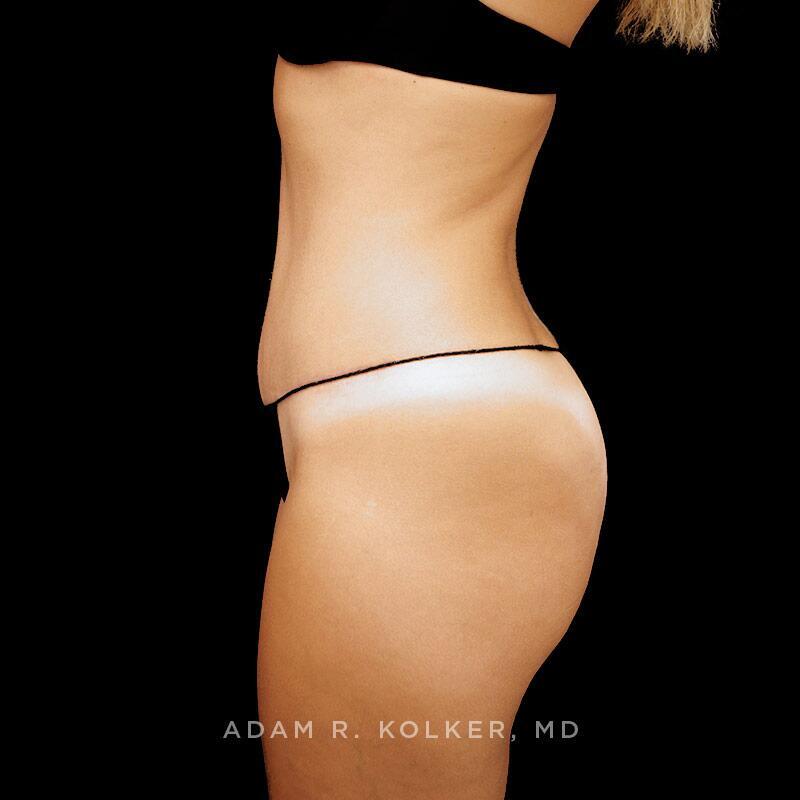 Tummy Tuck After Image Patient 08 Side View