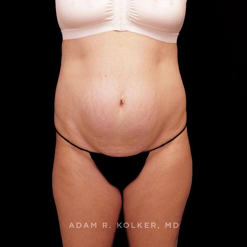 Tummy Tuck Before Image Patient 12 Front View