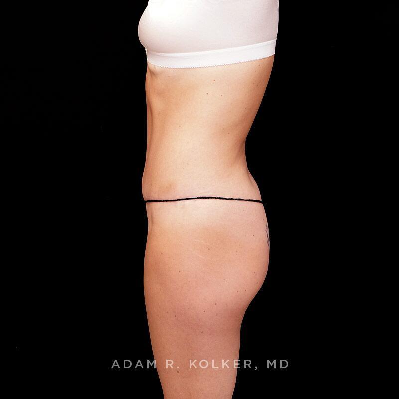 Tummy Tuck After Image Patient 12 Side View