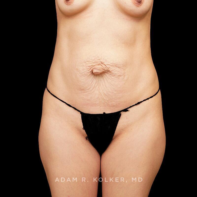 Tummy Tuck After Image Patient 13 Front View