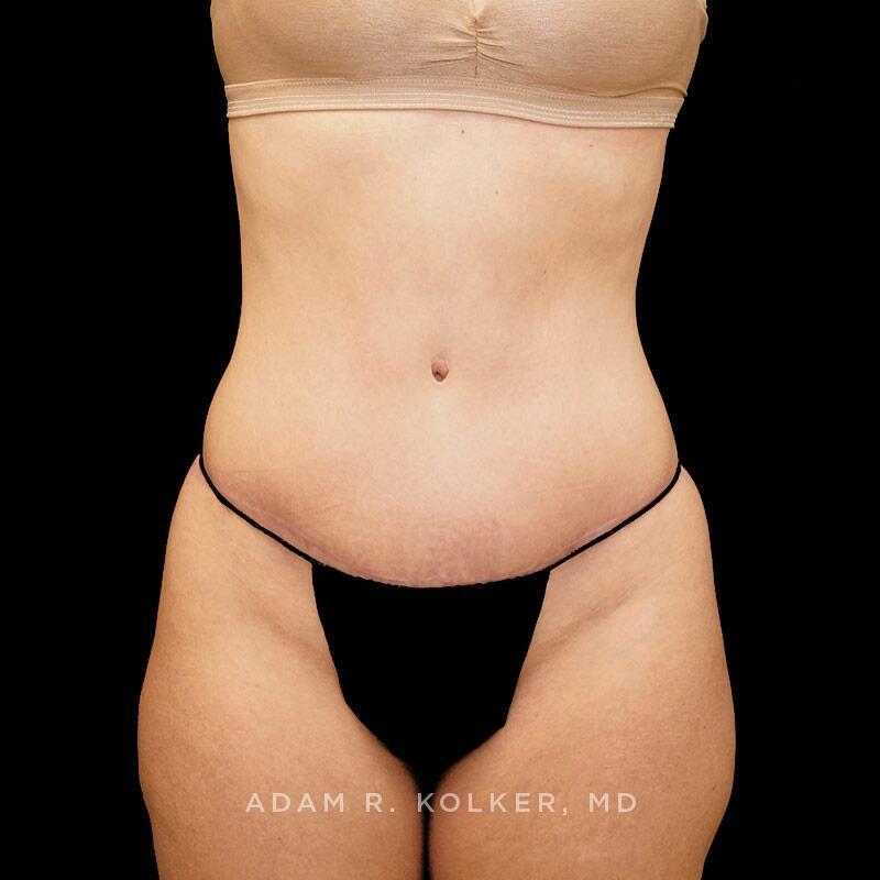 Tummy Tuck After Image Patient 15 Front View