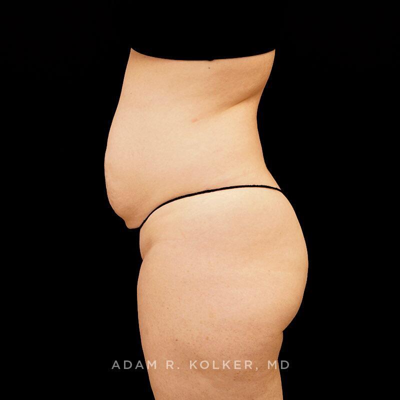 Tummy Tuck Before Image Patient 15 Side View