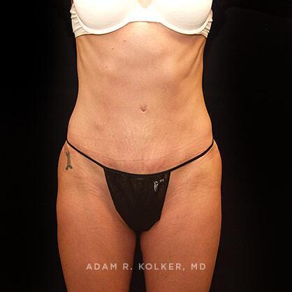 Tummy Tuck After Image Patient 17 Front View